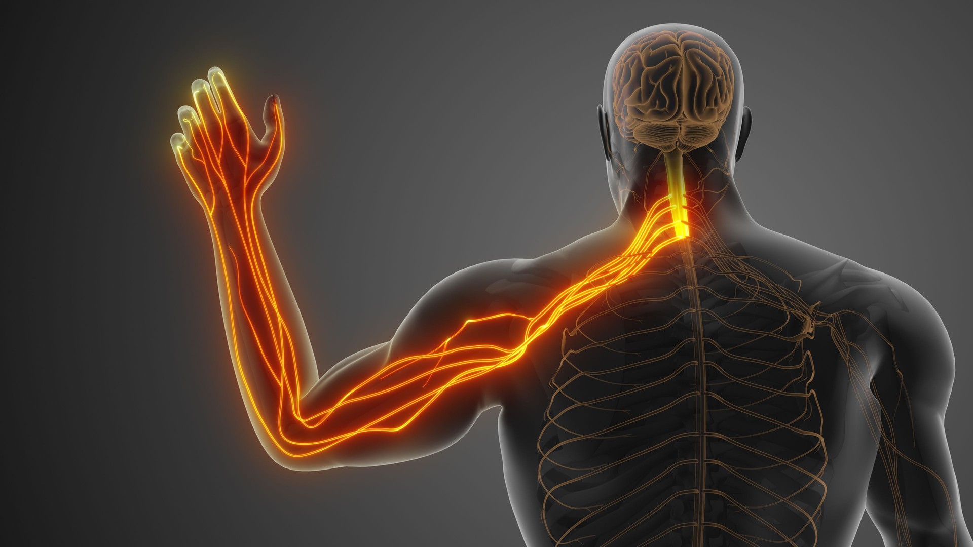Cervical Nerve Impingement Causing Neck and Arm Pain